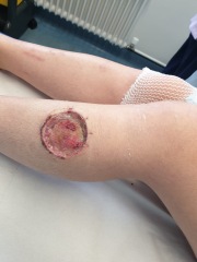Cancer wound