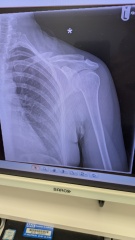 Clavicle break chances of op?