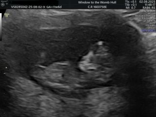 Nub at 11w4d