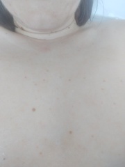 New moles/freckles in excess?