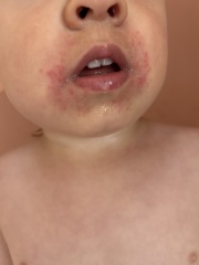 Almost 2 year old severe rash around mouth