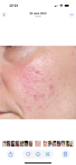 Skincare help - rosacea (?) treatments. Pic included