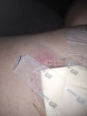 Normal after mole removal?