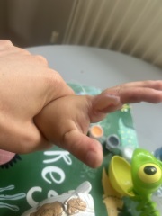 Child burnt at a forest preschool