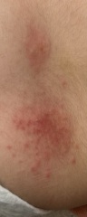 What kind of rash is this? Anybody used fucibet cream before?