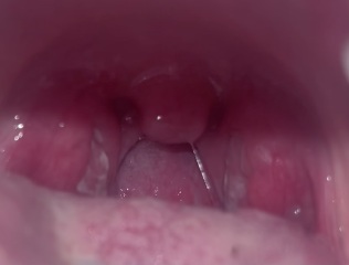 Is this tonsillitis or something else?