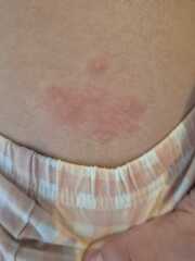 Rash on DD (12), seems to be getting worse