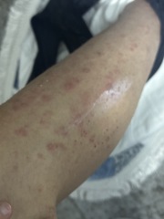 Rash