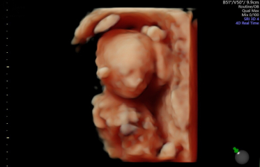 3d scan at 17 weeks 🥹🤍