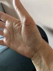 Pompholyx eczema