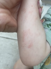 Rash on toddler - opinions greatly appreciated as very worried