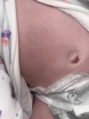 Baby rash