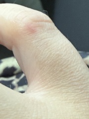 Small dog bite- worried AIBU