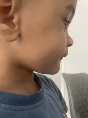 Dark veins on child’s face