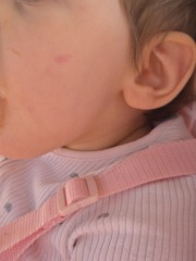 Red blotches when eating