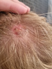 Fungal(?) infection that hasn't cleared in 8+ months