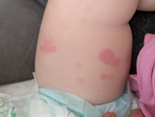 Hives ??? Advice please