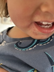 Almost 2 year old eczema around mouth