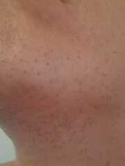 Hair removal due to pcos