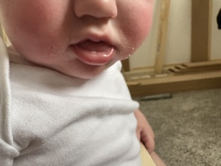 Baby rash on face