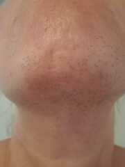 Hair removal due to pcos