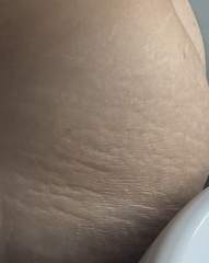 Lovely boyfriend doesn’t know how bad my stretch marks are yet.