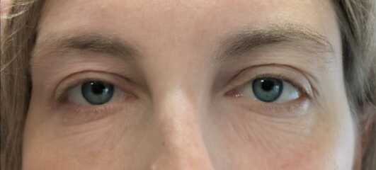 Eyes ageing me