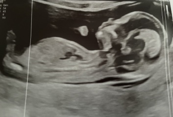13+3 week scan… Any gender guesses?? :)