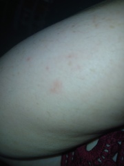 Delayed allergic reaction/hives on MJ