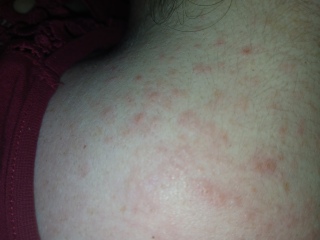Delayed allergic reaction/hives on MJ