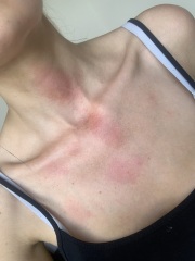 HELP! Burnt neck and chest with hot oil
