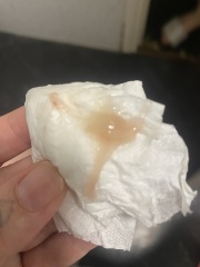 TMI pics! Mucus plug or bloody show?