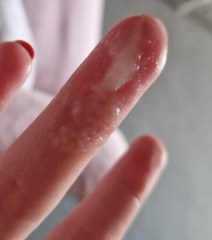 TMI CM Photos 4/5DPO