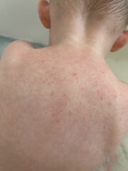 Is this chicken pox?