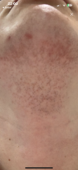 Hair removal due to pcos