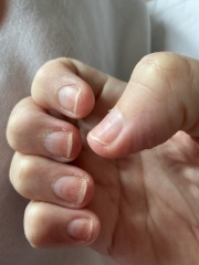 Terrible nails after builder gel removal