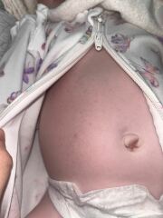 Baby rash