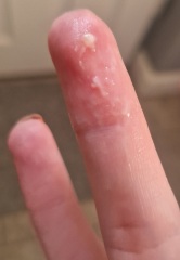 TMI CM Photos 4/5DPO