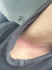 Red sore skin in both armpits - help!