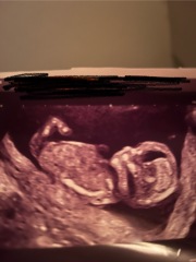 13 Week Scan Gender Guess