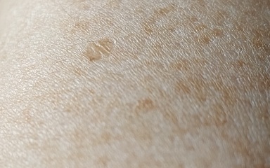 What are these shiny round patches on my hands and forearms?