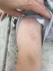 Rash on toddler - opinions greatly appreciated as very worried