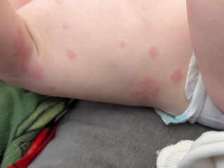 Hives ??? Advice please