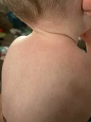 Is this chicken pox?