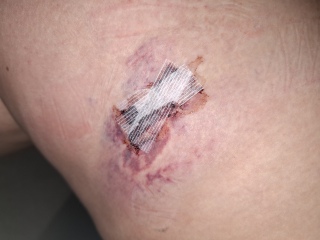 Normal after mole removal?