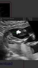 Boy or girl?? Any sonographers?