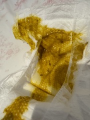 CMPA Baby Poop?