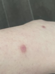 Mole or re lump