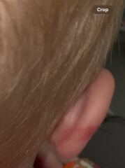 Ear bruise?