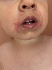 Almost 2 year old severe rash around mouth